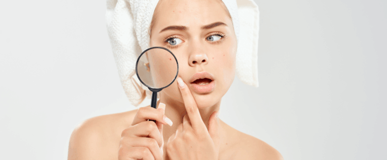 O czym pamiętać przy trądziku