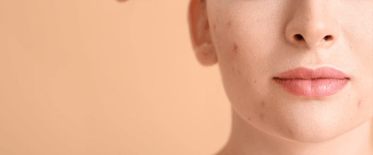 Trądzik – jak go zwalczyć?