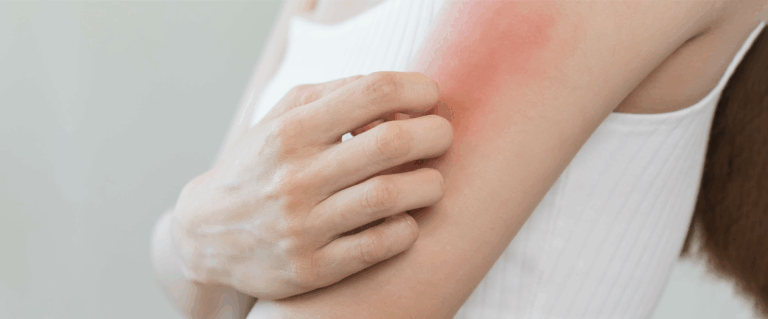 Letnie problemy skóry: jak walczyć z potówkami, przetłuszczaniem i przebarwieniami?