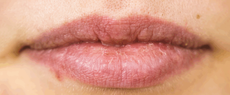 Co stosować na spierzchnięte, pękające usta?