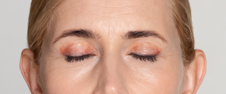 Przesuszone powieki zimą – przyczyny, objawy i skuteczna pielęgnacja