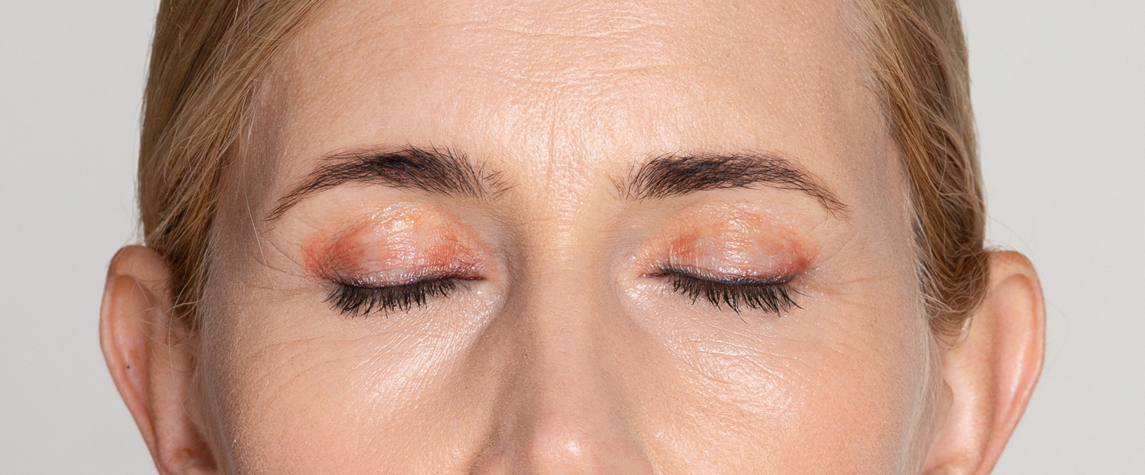 Przesuszone powieki zimą – przyczyny, objawy i skuteczna pielęgnacja