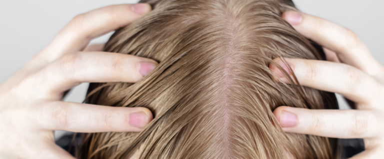 Przetłuszczające się włosy – przyczyny i skuteczne sposoby na tłustą skórę głowy